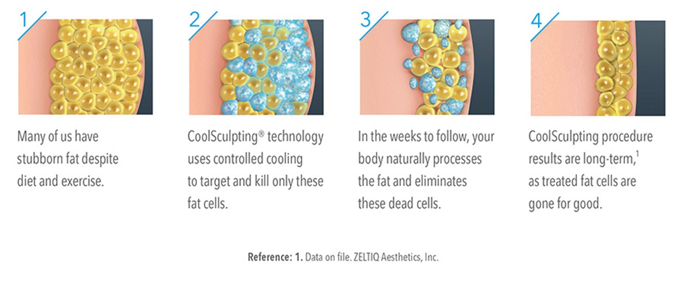 coosculpting 4 step treatment