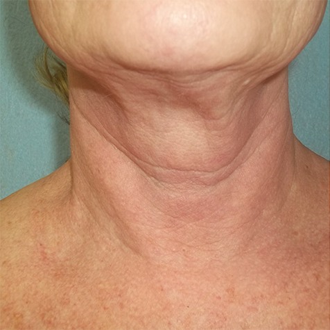 Fractora Before Photo