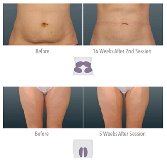 CoolSculpting recovery