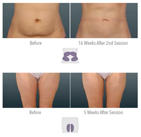 Recovery Tips After Your Tummy Tuck [Infographic] - Northwest