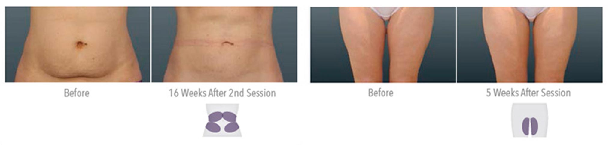 CoolSculpting recovery