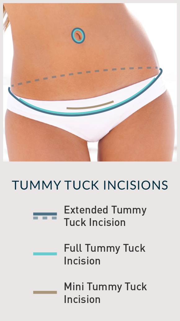 tummy tuck incisions 