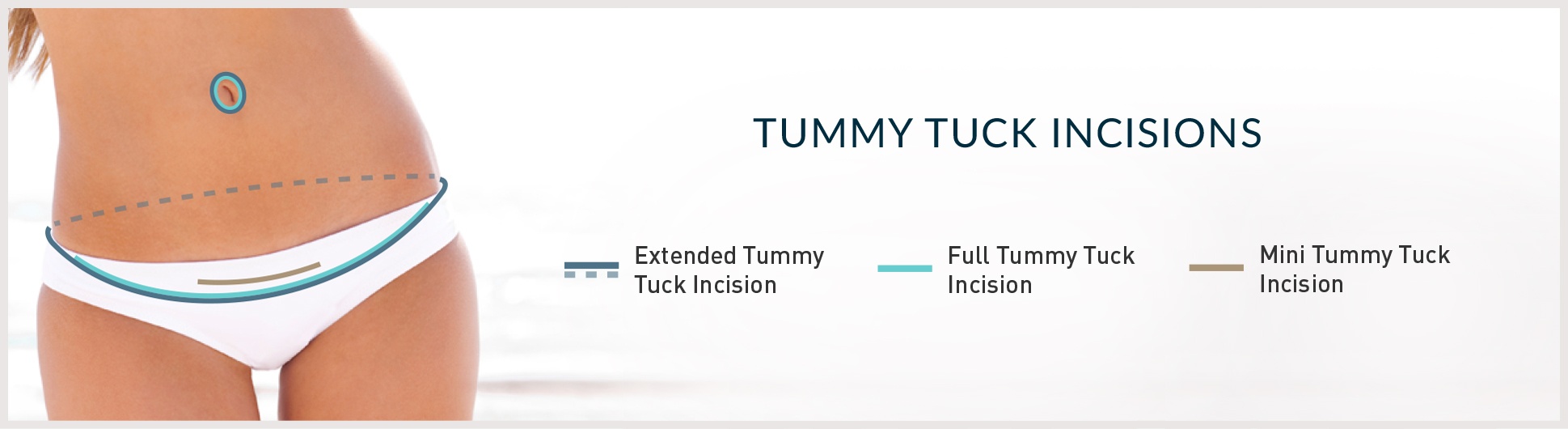 tummy tuck incisions illustration