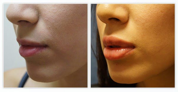 Before and After Juvederm for lip injections