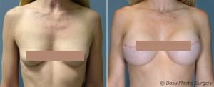 houston breast reconstruction photo