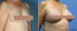 houston breast reconstruction photo