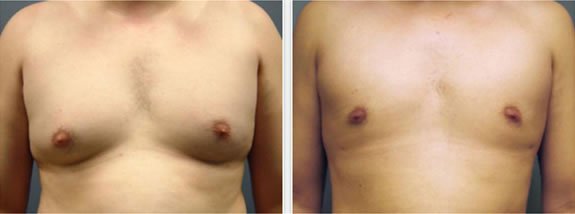 Male Breast Reduction Before and After