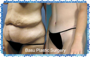 tummy tuck before and after photo