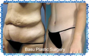 tummy tuck before and after photo