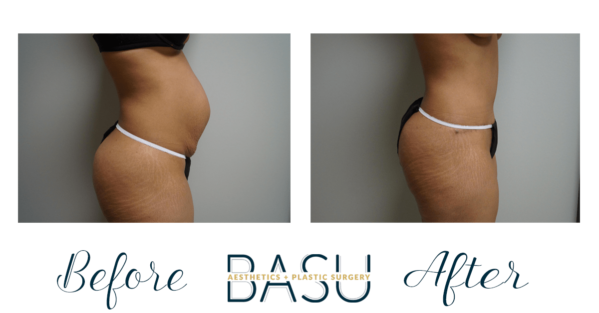 Before and After Tummy Tuck at Basu Plastic Surgery