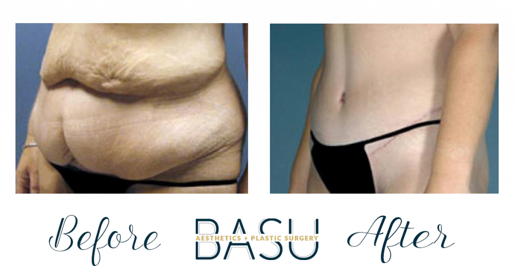 Before and After Tummy Tuck at Basu Plastic Surgery