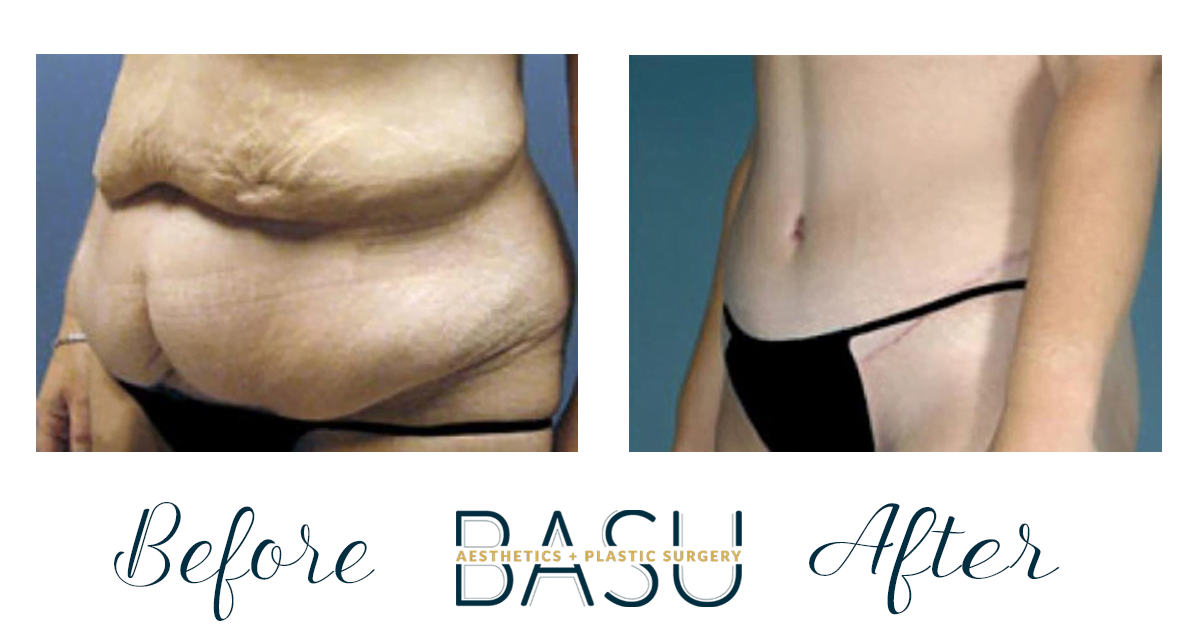 Best Tummy Tuck Austin Tx