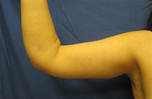 ARM LIFT CASE 18