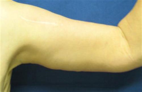 ARM LIFT CASE 19