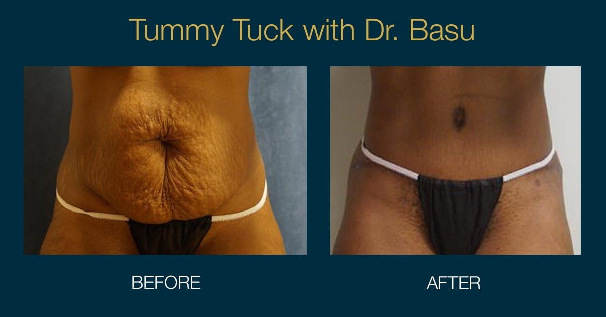 Why Tummy Tuck is a great option after pregnancy.