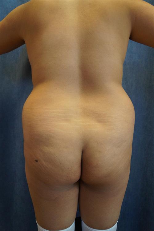 BRAZILIAN BUTT LIFT (BBL) CASE 44