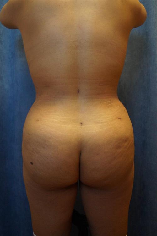 BRAZILIAN BUTT LIFT (BBL) CASE 44