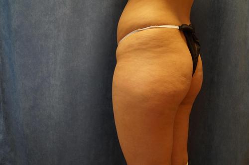 BRAZILIAN BUTT LIFT (BBL) CASE 46