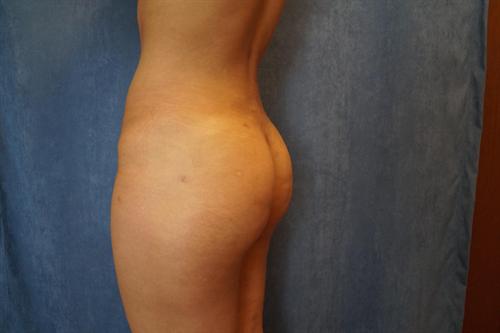 BRAZILIAN BUTT LIFT (BBL) CASE 46