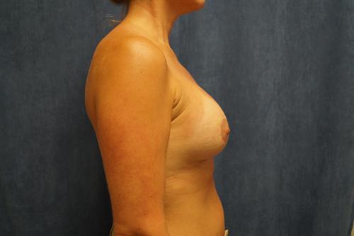 BREAST AUGMENTATION WITH LIFT CASE 173 – Image 1