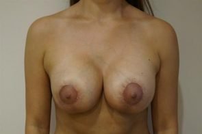 BREAST AUGMENTATION WITH LIFT CASE 174 – Image 3