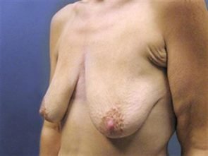 BREAST AUGMENTATION WITH LIFT CASE 182 – Image 4