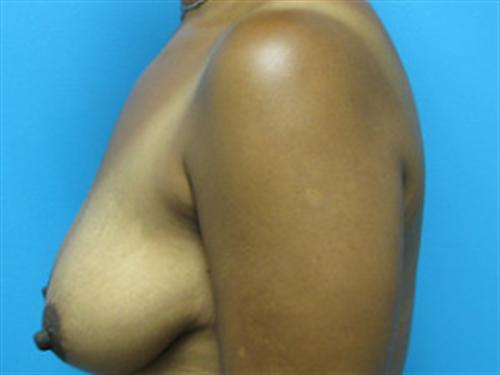 BREAST AUGMENTATION WITH LIFT CASE 184