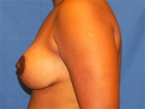 BREAST AUGMENTATION WITH LIFT CASE 184 – Image 1