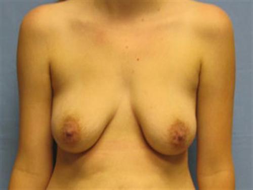 BREAST AUGMENTATION WITH LIFT CASE 185