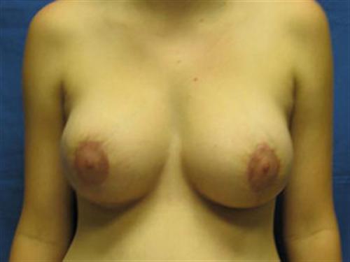 BREAST AUGMENTATION WITH LIFT CASE 185 – Image 1