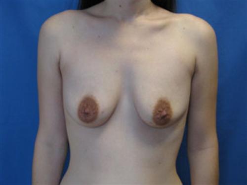 BREAST AUGMENTATION WITH LIFT CASE 186 – Image 4