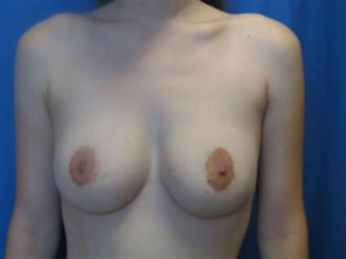 BREAST AUGMENTATION WITH LIFT CASE 186