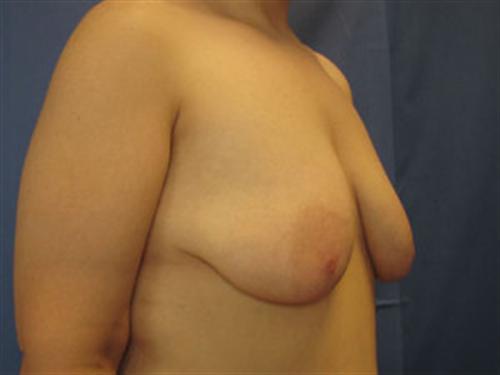 BREAST AUGMENTATION WITH LIFT CASE 187
