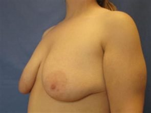 BREAST AUGMENTATION WITH LIFT CASE 187 – Image 2
