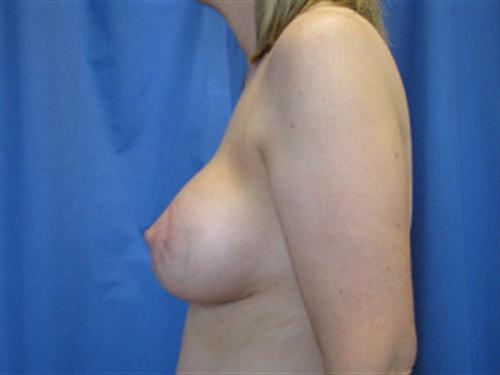 BREAST AUGMENTATION WITH LIFT CASE 189 – Image 3