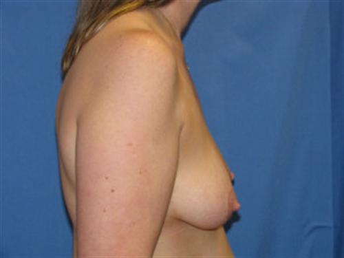 BREAST AUGMENTATION WITH LIFT CASE 189 – Image 2