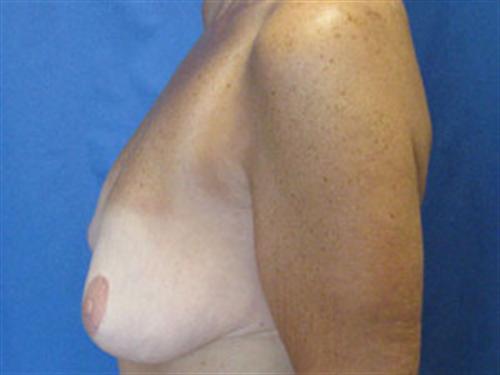 BREAST AUGMENTATION WITH LIFT CASE 190