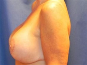 BREAST AUGMENTATION WITH LIFT CASE 190 – Image 3