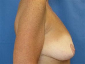 BREAST AUGMENTATION WITH LIFT CASE 190 – Image 2