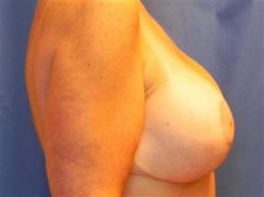 BREAST AUGMENTATION WITH LIFT CASE 190 – Image 1
