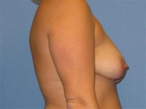 BREAST AUGMENTATION WITH LIFT CASE 191 – Image 4