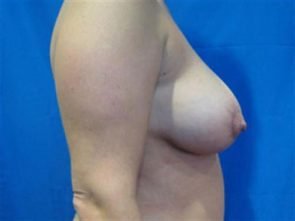 BREAST AUGMENTATION WITH LIFT CASE 191 – Image 3