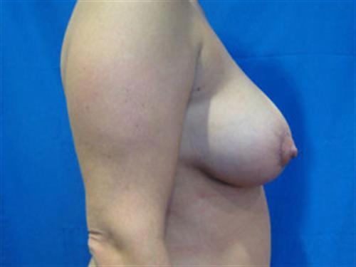 BREAST AUGMENTATION WITH LIFT CASE 191