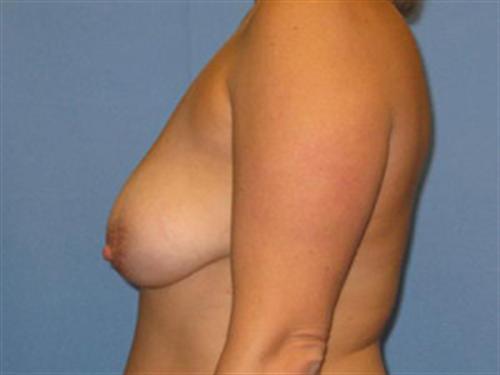 BREAST AUGMENTATION WITH LIFT CASE 191 – Image 2