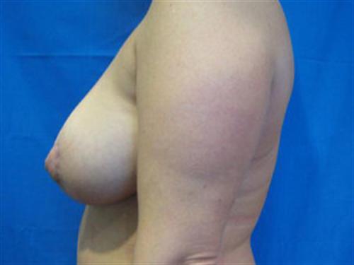 BREAST AUGMENTATION WITH LIFT CASE 191 – Image 1