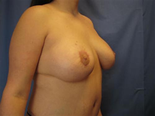 BREAST AUGMENTATION WITH LIFT CASE 192