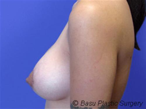 BREAST AUGMENTATION WITH LIFT CASE 193 – Image 1