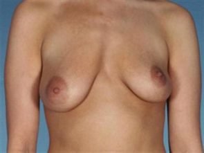 BREAST AUGMENTATION WITH LIFT CASE 195 – Image 4
