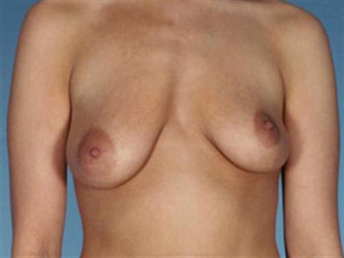 BREAST AUGMENTATION WITH LIFT CASE 195