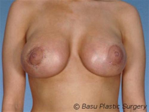 BREAST AUGMENTATION WITH LIFT CASE 195 – Image 3